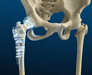 right hip orif icd 10.